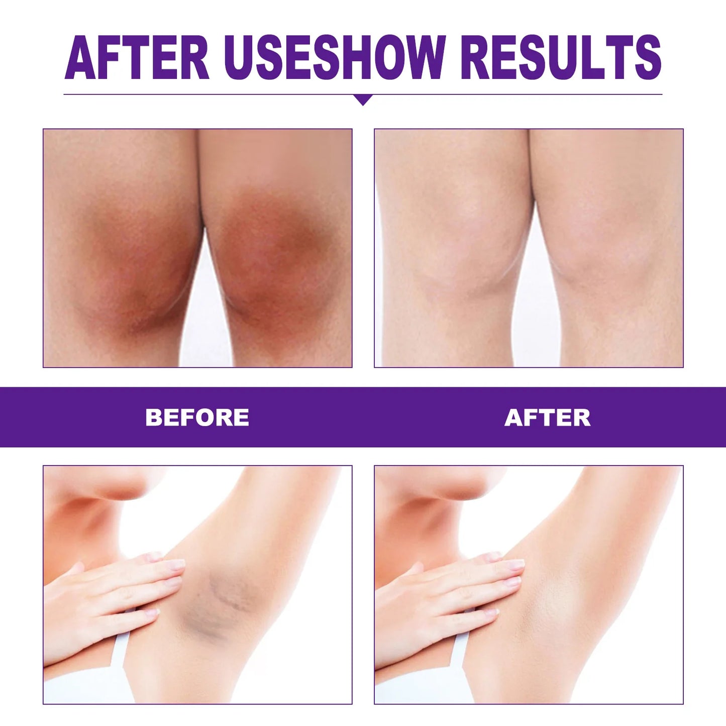 Body Whitening Cream - Intimate Areas Lips Armpits Knees Buttocks
